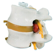 3B Scientific Human Anatomy - 2 Lumbar Vertebrae Models with Prolapsed Disc Flexibly Mounted