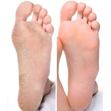 Advanced Clinicals Total Foot Renew Cream- Relief for Dry Itchy Skin, Tough Calluses, Cracked Heel. 8oz