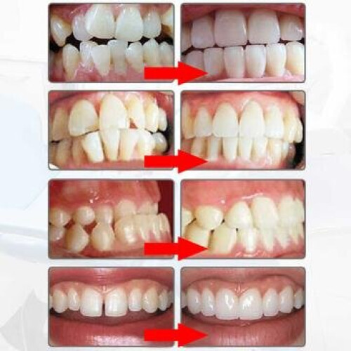 (D1 D2 D3) Teeth Whitening Dental Braces Dental  Retainers 2