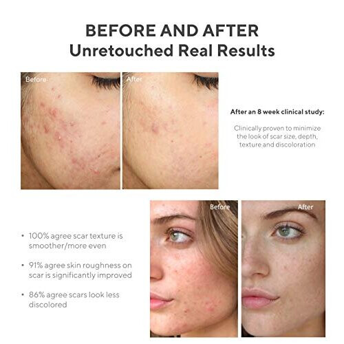 Murad Murad, Acne Control, InvisiScar, Resurfacing Behandeling, 0,5 fl oz (15 ml) 2
