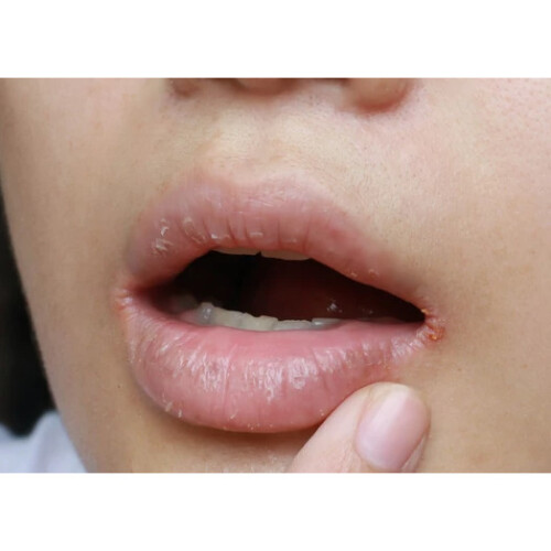 Zajadex, lip ointment, 10 ml, masc na zajady 2