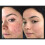 ACNELYSE Skin Cream Acne Treatment Retinoic Acid 0.1% 8