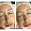 ACNELYSE Skin Cream Acne Treatment Retinoic Acid 0.1% 5