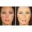 ACNELYSE Skin Cream Acne Treatment Retinoic Acid 0.1% 9