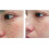 ACNELYSE Skin Cream Acne Treatment Retinoic Acid 0.1% 13