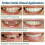 Smile Snap On Upper False Teeth Dental Veneers Dentures Tooth Cover Set 9