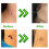 Micro Skin Tag Remover device - Mole wart removal kit- Acne, Pimple 2