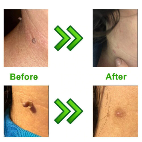 Micro Skin Tag Remover device - Mole wart removal kit- Acne, Pimple 1