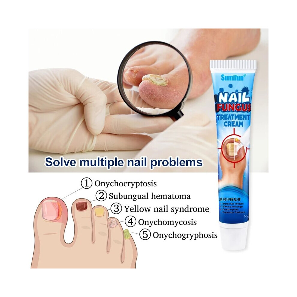 Chinese Herbal Toe Nail Fungus Treatment Cream Onychomycosis Paronychia
