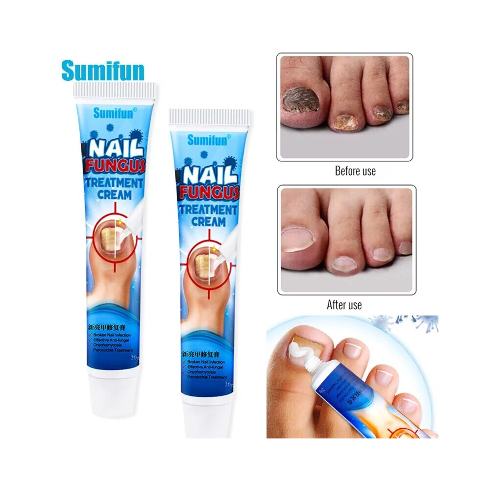 Anti Fungal Treatment Nail Ointment, Onychomycosis Paronychia Infection  Herbal, Fights Ringworm On Skin, Powerful Topical Treatment - Walmart.com