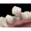 STRONG, Permanent Dental Cement For Caps, Crowns, Bridges, Posts, 4