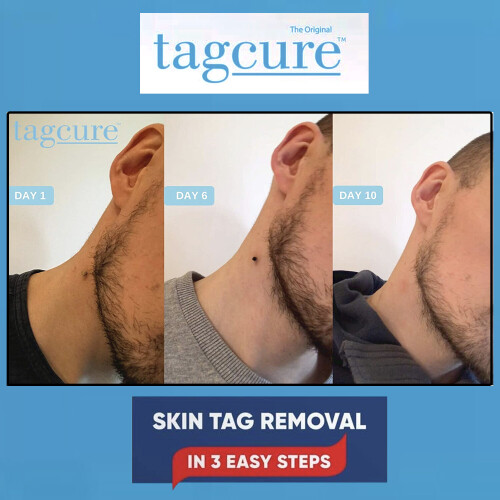 Tagcure Skin Tag Removal Kit Includes Tag Bands Swabs & Plasters 2