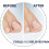 Scholl Scholl Ingrown Toenail Treatment Kit 3