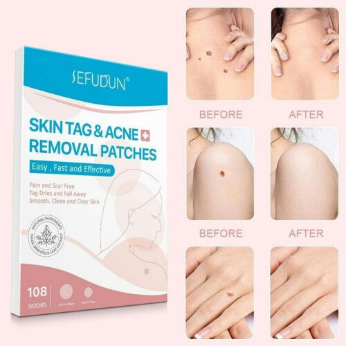 Skin Mole Removal Patch  (108 Pcs) 1