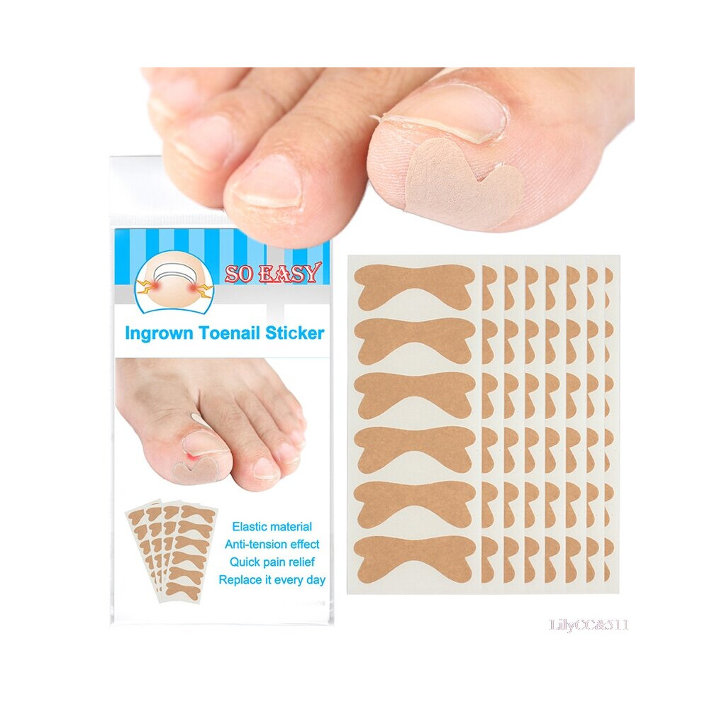 Hkhbjs (48Pcs) Nail Correction Stickers Ingrown Toenail Corrector Patches Paronychia Treatment