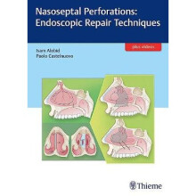Nasoseptal Perforations Endoscopic Repair Techniques