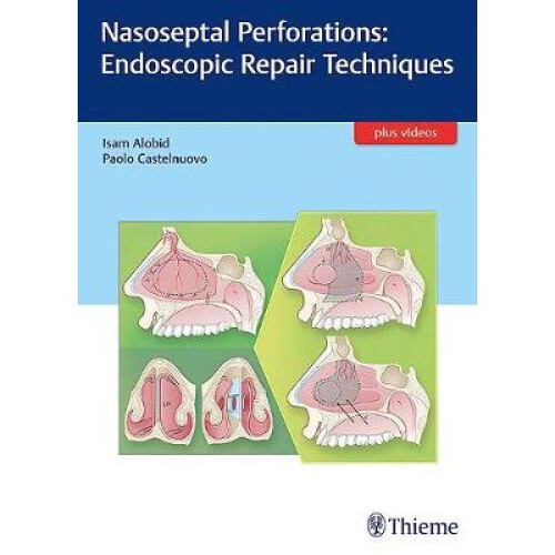 Nasoseptal Perforations Endoscopic Repair Techniques
