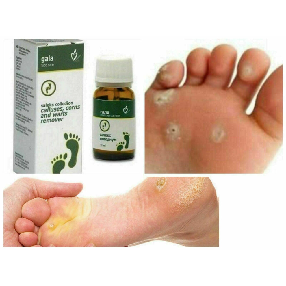 Remove CALLUSES CORNS & WARTS With Gala Foot & Skin Care LACTIC Acid