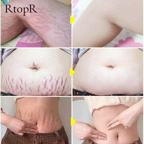 40g RtoprR Mango Pregnancy Stretch Scars Marks Remove Cream 1