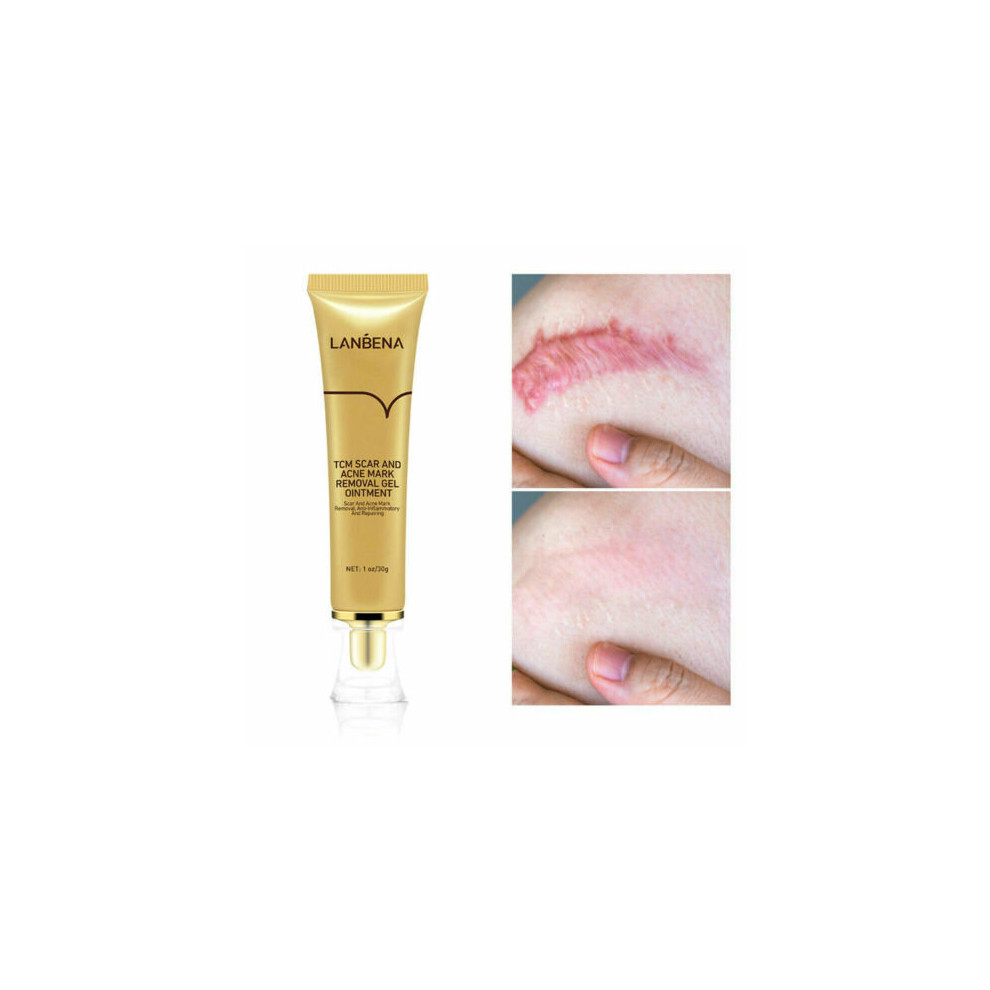 Women TCM SCAR AND ACNE MARK REMOVAL GEL OINTMENT Acne Scar Cream 2021