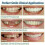 Snap On Top και Bottom Veneers Οδοντοστοιχίες Ψεύτικα δόντια Κάλυψη οδοντικών δοντιών 7
