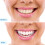 Snap On Top και Bottom Veneers Οδοντοστοιχίες Ψεύτικα δόντια Κάλυψη οδοντικών δοντιών 9