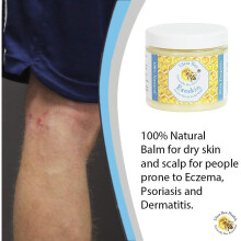 100% Natural Exeskin Balm 200ml - Soothes Dry Sensitive Skin and Dry Itchy Scalp - Also Suitable for People Prone to Eczema Psoriasis, Dermatitis, Ros