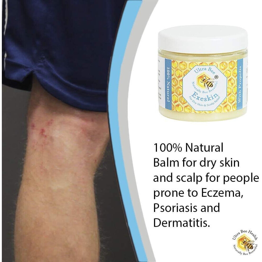 100% Natural Exeskin Balm 200ml - Soothes Dry Sensitive Skin and Dry Itchy Scalp - Also Suitable for People Prone to Eczema Psoriasis, Dermatitis, Ros