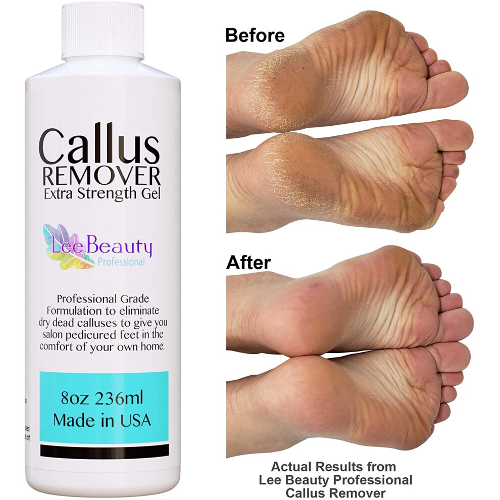 Lee beauty hot sale professional callus remover