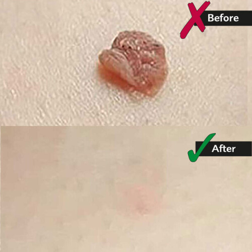 Auto Skin Tag Remover Kit 1