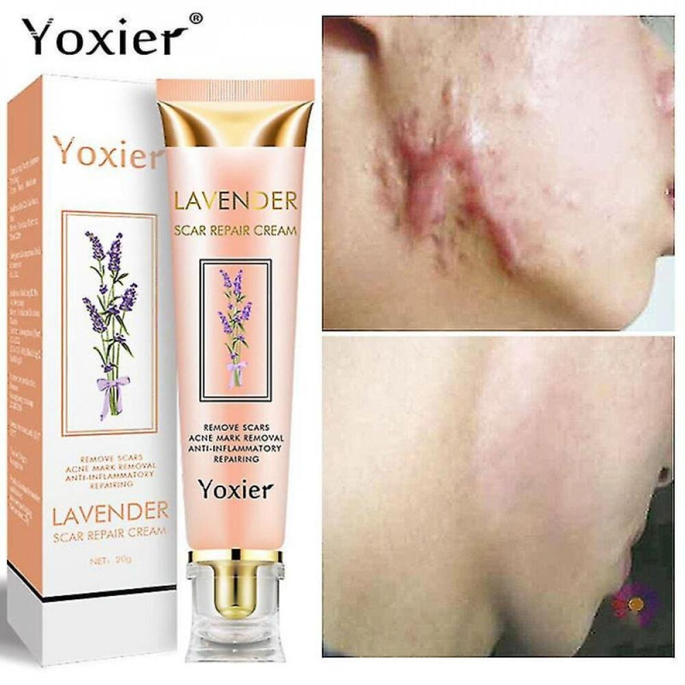 Acne Scar Repair Cream Acne Scar Removal Pigmentation Corrector Remove Stretch Marks Smooth Skin Whitening Scar Care