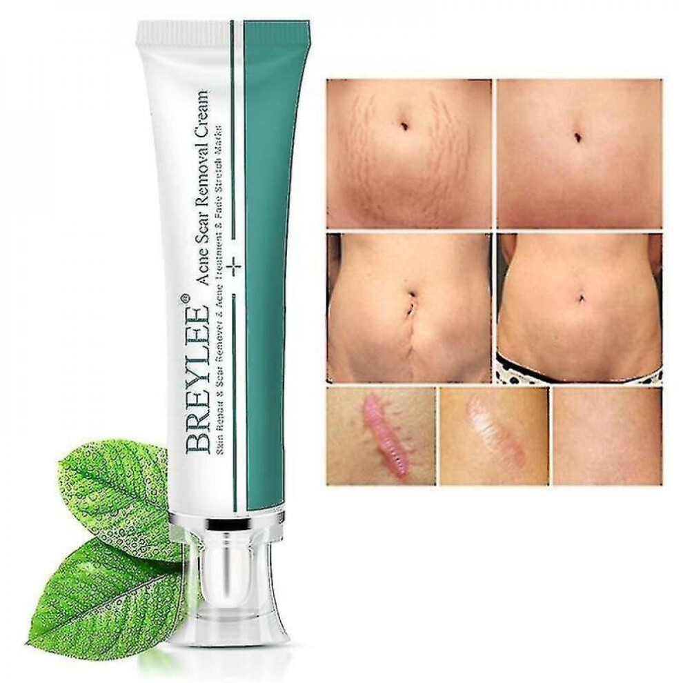 New Face Pimples Scar Stretch Marks Removal Acne Treatment Whitening Moisturizing Sm362