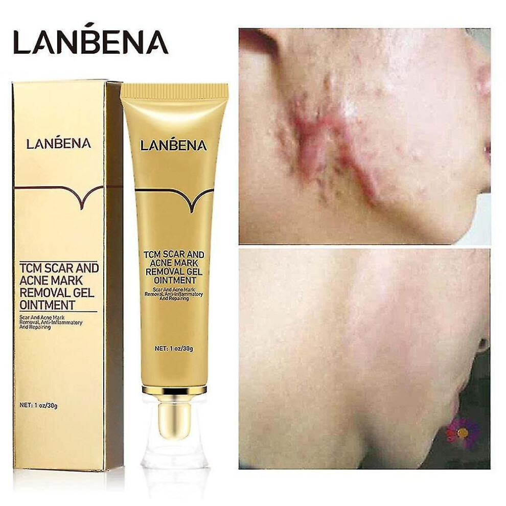 Acne Scar Removal Cream Pimples Scars Repair Gel Stretch Marks Remove Burn Surgical Scar Treatment Serum Body Skin Care