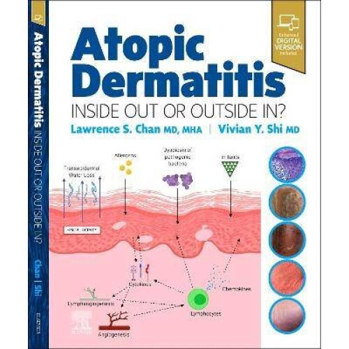 Atopic Dermatitis