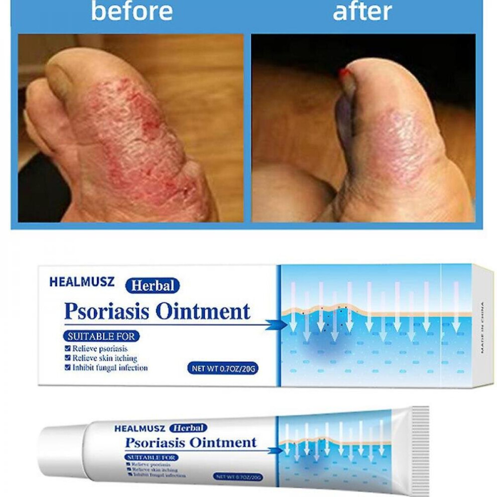Hkhbjs Cream Antil Skin Psoriasis Eczema Anti-Itng Relief Rash Urtic Fla Care