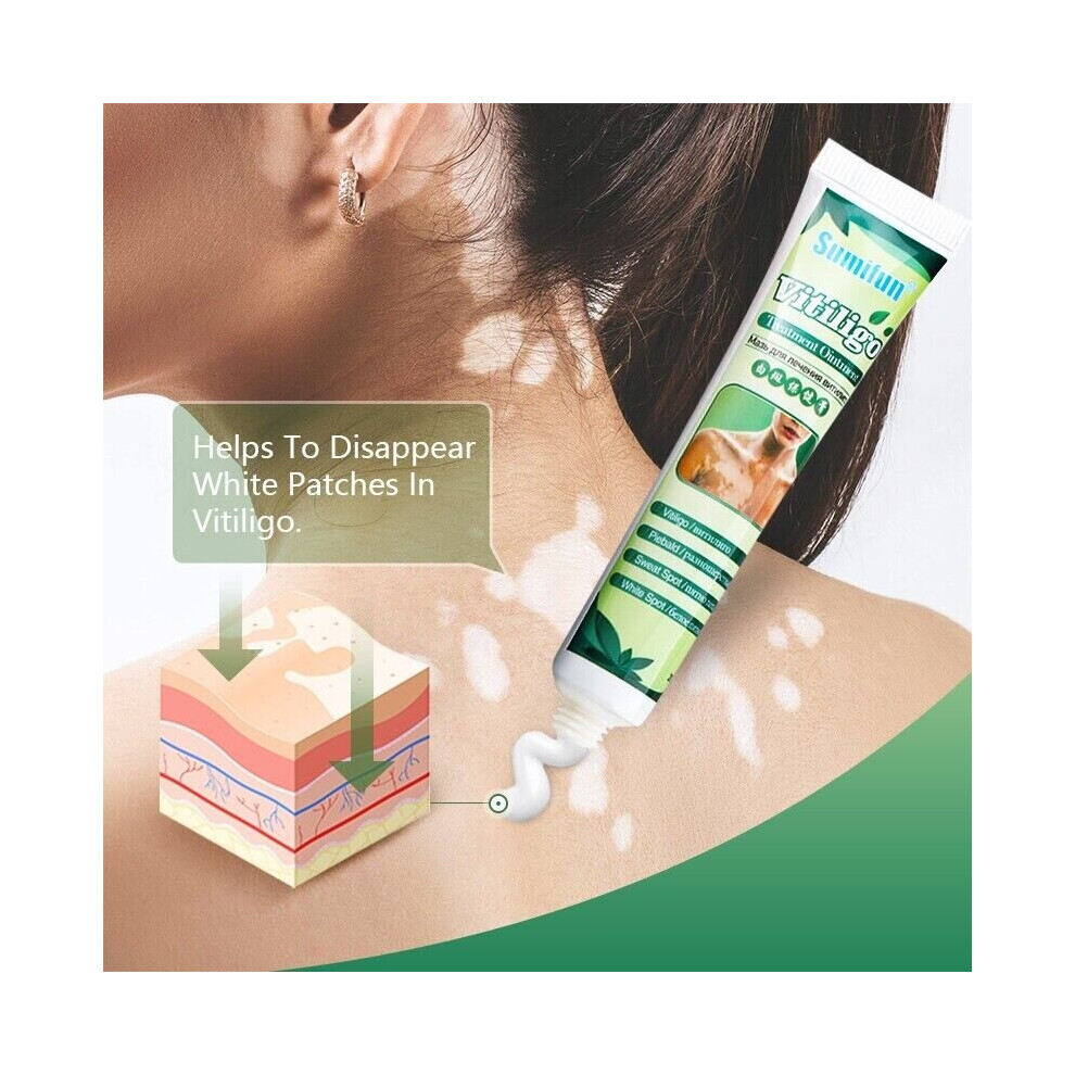 Skesrjtop White New Vitiligo Treament Ointment Leukoplakia Antibacterial Spot