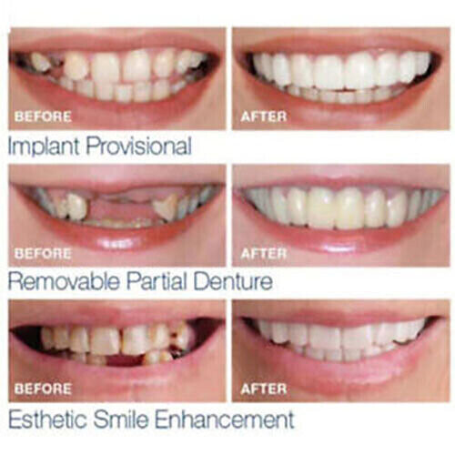 On False Teeth Upper + Lower Dental Veneers Dentures Tooth Cover Set 2