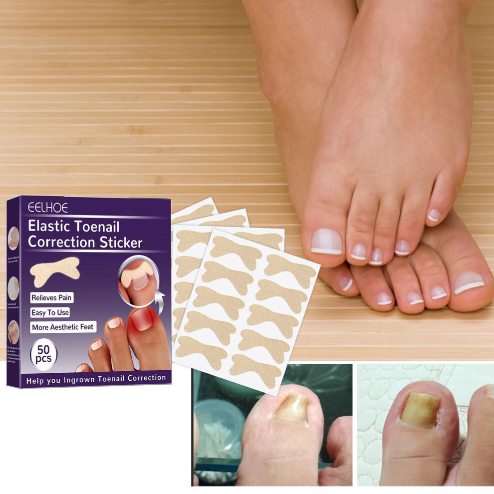 Srj Star 50Pcs Fertoe Toenail Corrector Patch Ingrown Toe Nail Correction Sticke