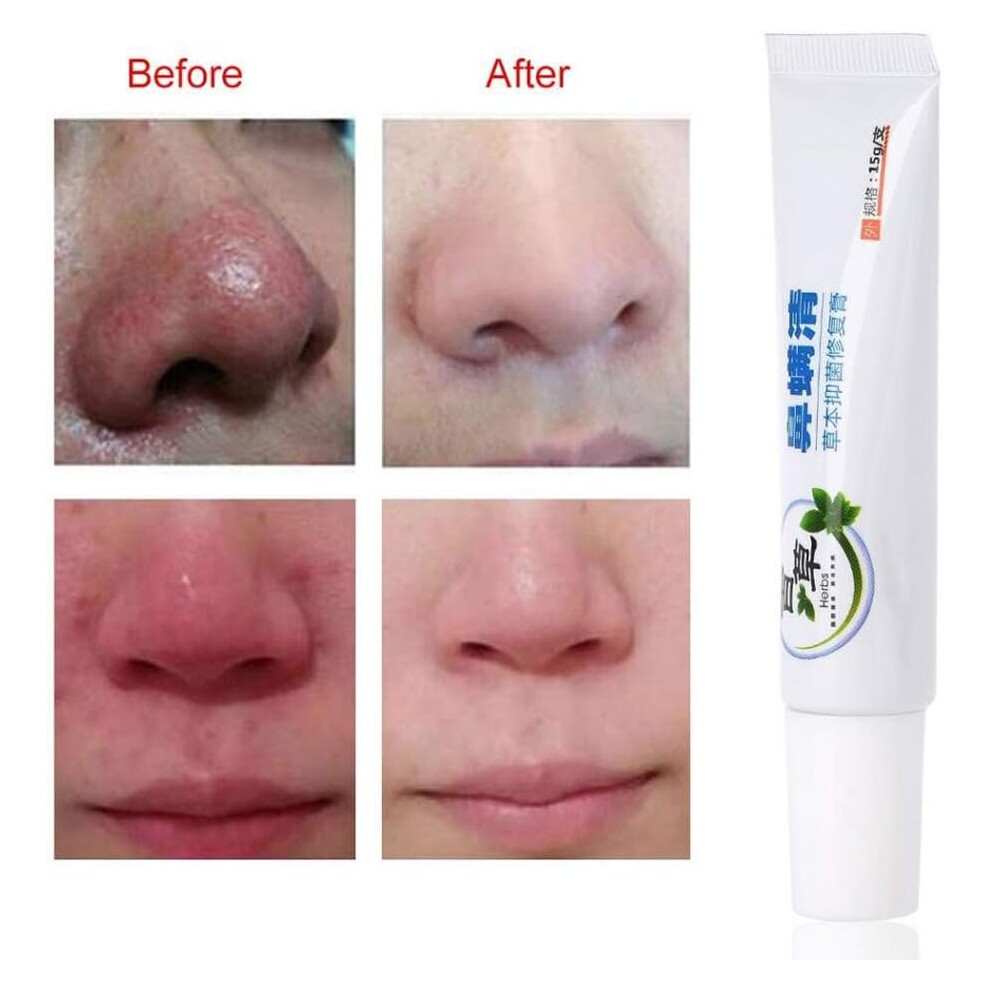 Rosacea Cream Treatment Skin Care Pores Products for Face Redness Relief, Inflammatory & Anti Acne, Moisturizing, Suppress Bacteria and Itching Cream