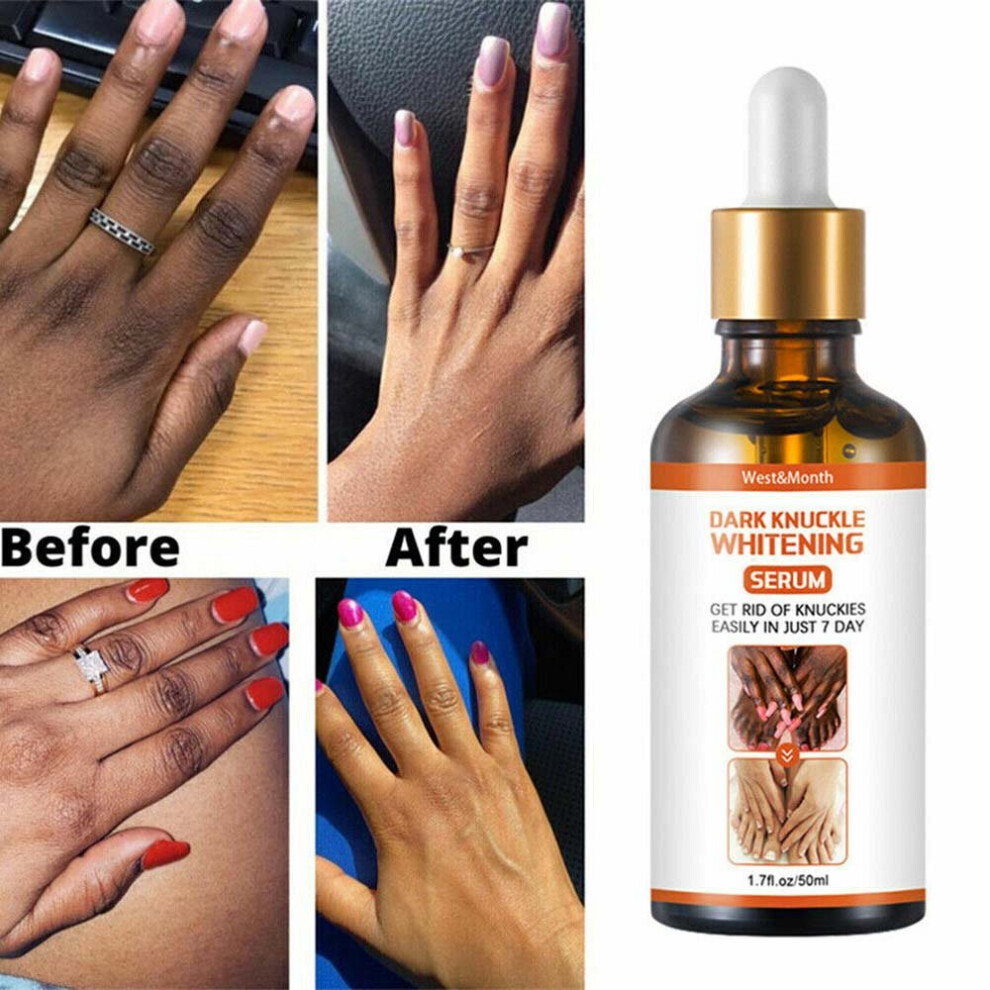 50g West&Month Acanthosis Nigricans Therapy Oil  Permanent Whitening