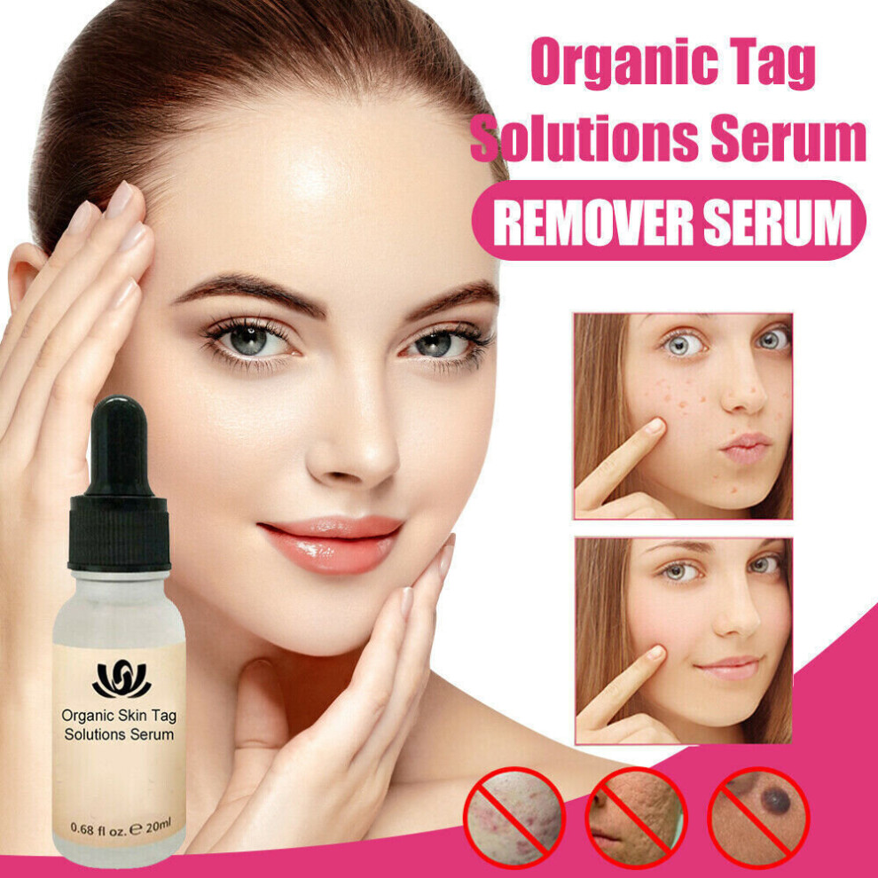 Xylfly Wart Remover Pen Skin Tag Mole Remover Eliminate Foot Corn Warts Unisex