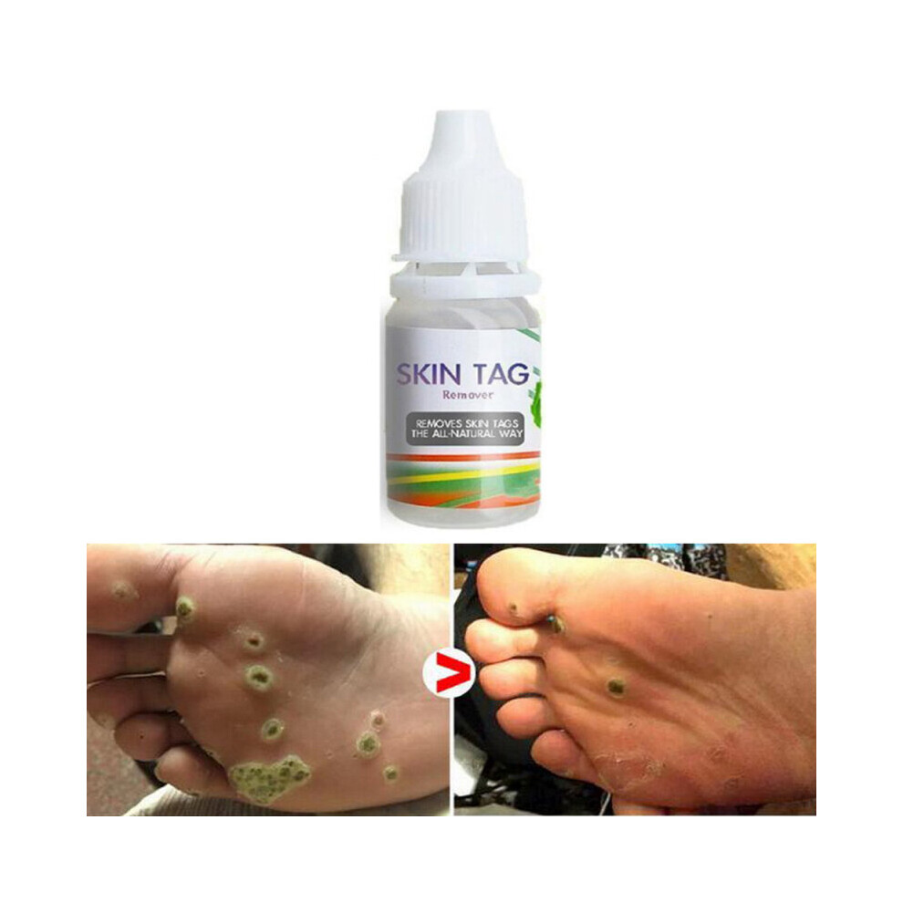 Wejoy Chinese Medicine Treatment Skin Warts Removal Foot Corn Removal Plantar Warts Pomada De Verruga Skin Care Medical Ointment