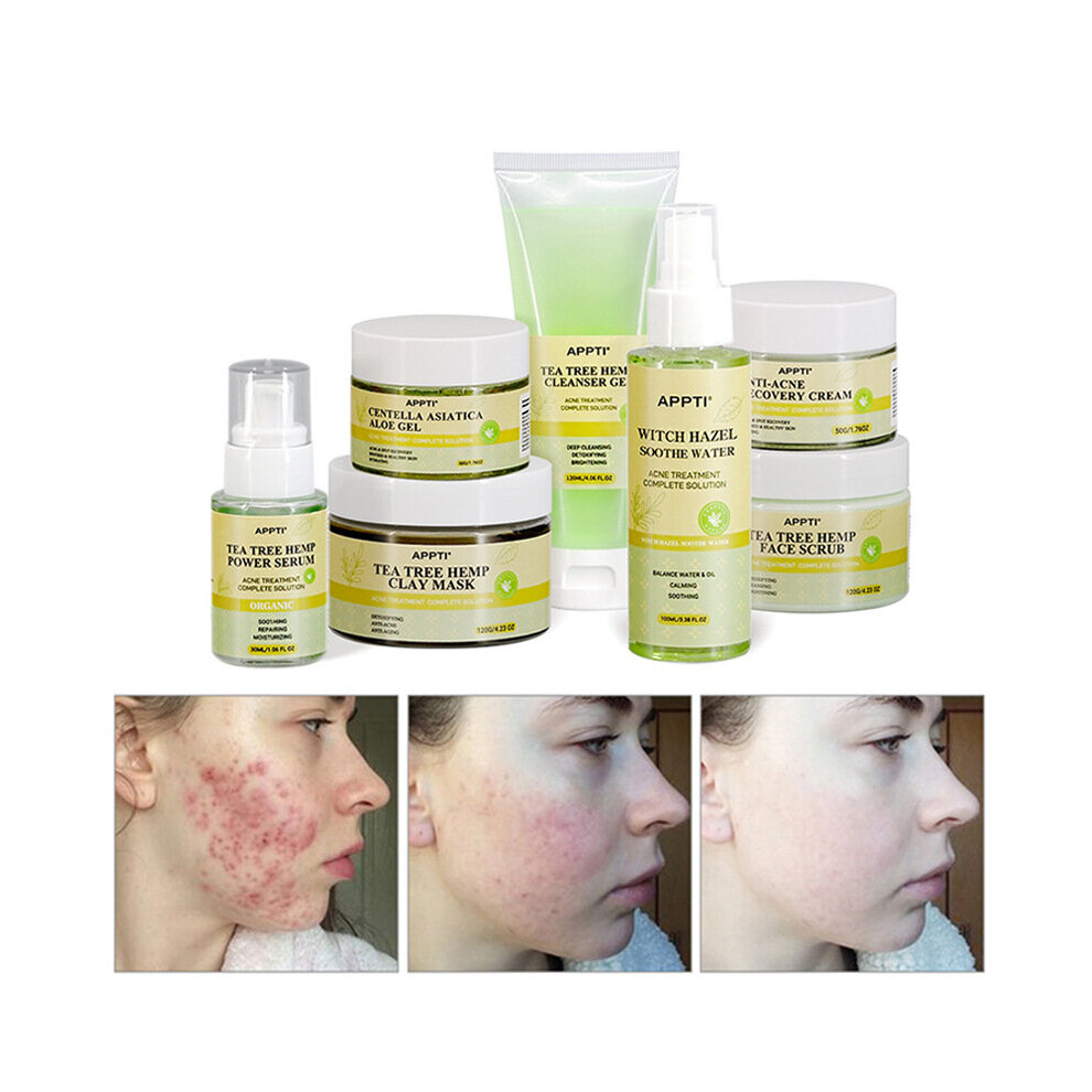 Wejoy Cream Tea Tree Acne Treatment Facial Set Efectively Remove Blackheads Acne Scars Shrink Pores Repair Serum Skin Care Kit Product