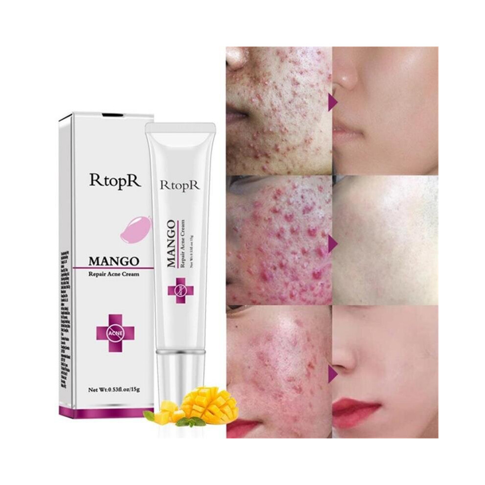 Wejoy Cream Rtopr Mango Repair Acne Whitening Moisturizing Face Anti-Acne Treatment Shrinks Pore Day S Skin Care Tslm2