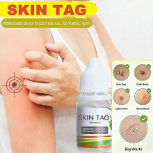New Safe Fast Skin Tag Remover Liquid Mole Wart Acne Pimple Patch Removal Spot