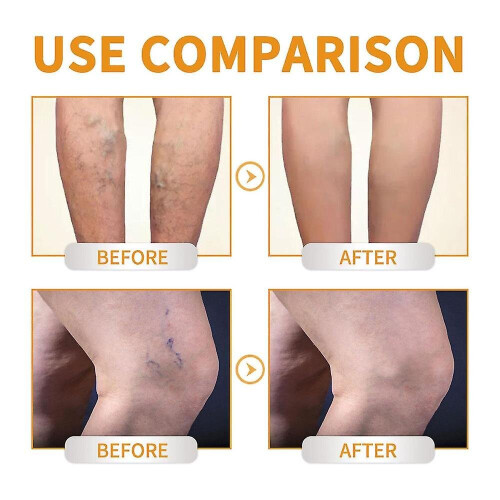 Vitamin K Cream For    Bruising  s - s Soothe 2