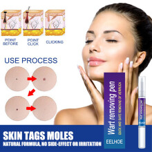 2PCS LIQUID WART REMOVER PEN NATURAL TREATMENT MOLES SKIN TAG SAFE VERRUCA