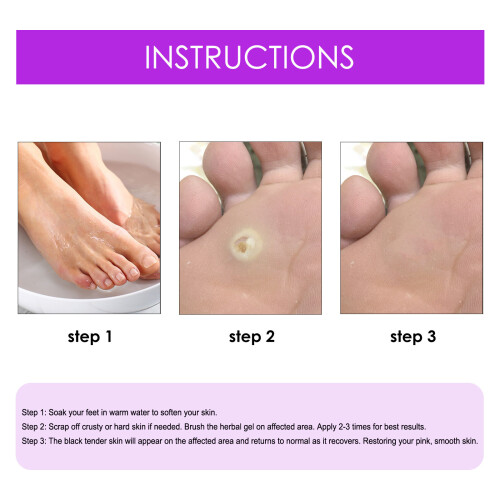 NEW WART REMOVAL OINTMENT REMOVE SKIN TAGS & WARTS. NATURAL SAFE 1