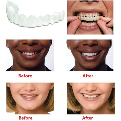 Snap on Teeth Veneers,Perfect Teeth Temporary Replacement Fake Veneers Kit-2 Boxes 1
