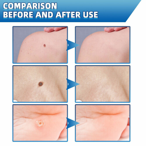 iBeaLee Skin Tag Remover Fast Effective Safe 20ml. 1